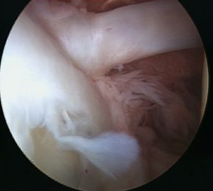 Arthroscopy Meniscoid Biceps Insertion